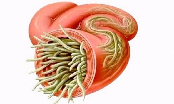 worms in human intestine