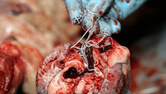 Helminths in the heart